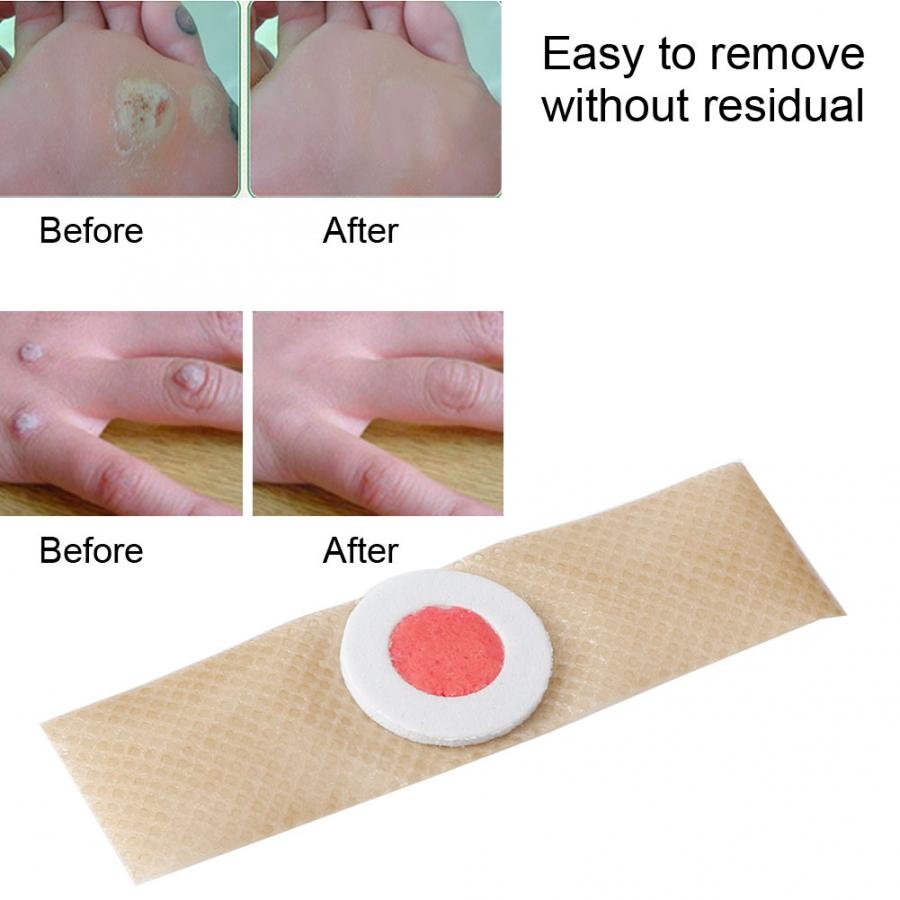 Foot Care 6Pcs/Bag Foot Corn Removal Plaster Warts Thorn Patch Feet Callus Remove Pain Relief Stickers Massage Relaxation